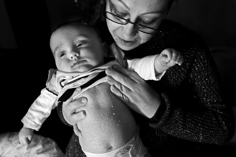 Stacy Morris checks on her daughter, Madison Morris', skin at their home in Fall River, MA.  Madison Morris, 5 months, is affected by a rare skin disorder called ichthyosis.  Madison's skin doesn't function normally due to a genetic mutation inherited at birth, leaving her skin dry, thickened and scaly.  PHOTO PETER PEREIRA