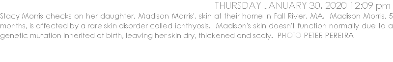 Stacy Morris checks on her daughter, Madison Morris', skin at their home in Fall River, MA.  Madison Morris, 5 months, is affected by a rare skin disorder called ichthyosis.  Madison's skin doesn't function normally due to a genetic mutation inherited at birth, leaving her skin dry, thickened and scaly.  PHOTO PETER PEREIRA